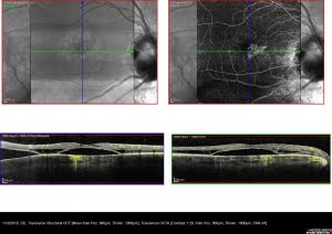 Downloadable Amsler Grid - Central Triad Retina Physicians